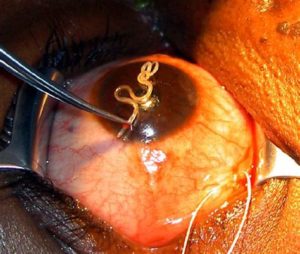 keralanews 18cm worm removed from mans eye