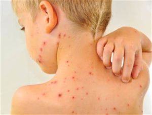 keralanews chickenpox is spreading in the state and alert issued