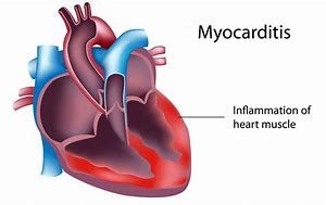 keralanews college student dies of myocarditis in kannur