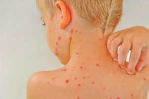 keralanews report that chickenpox is spreading in the district health department issues alert